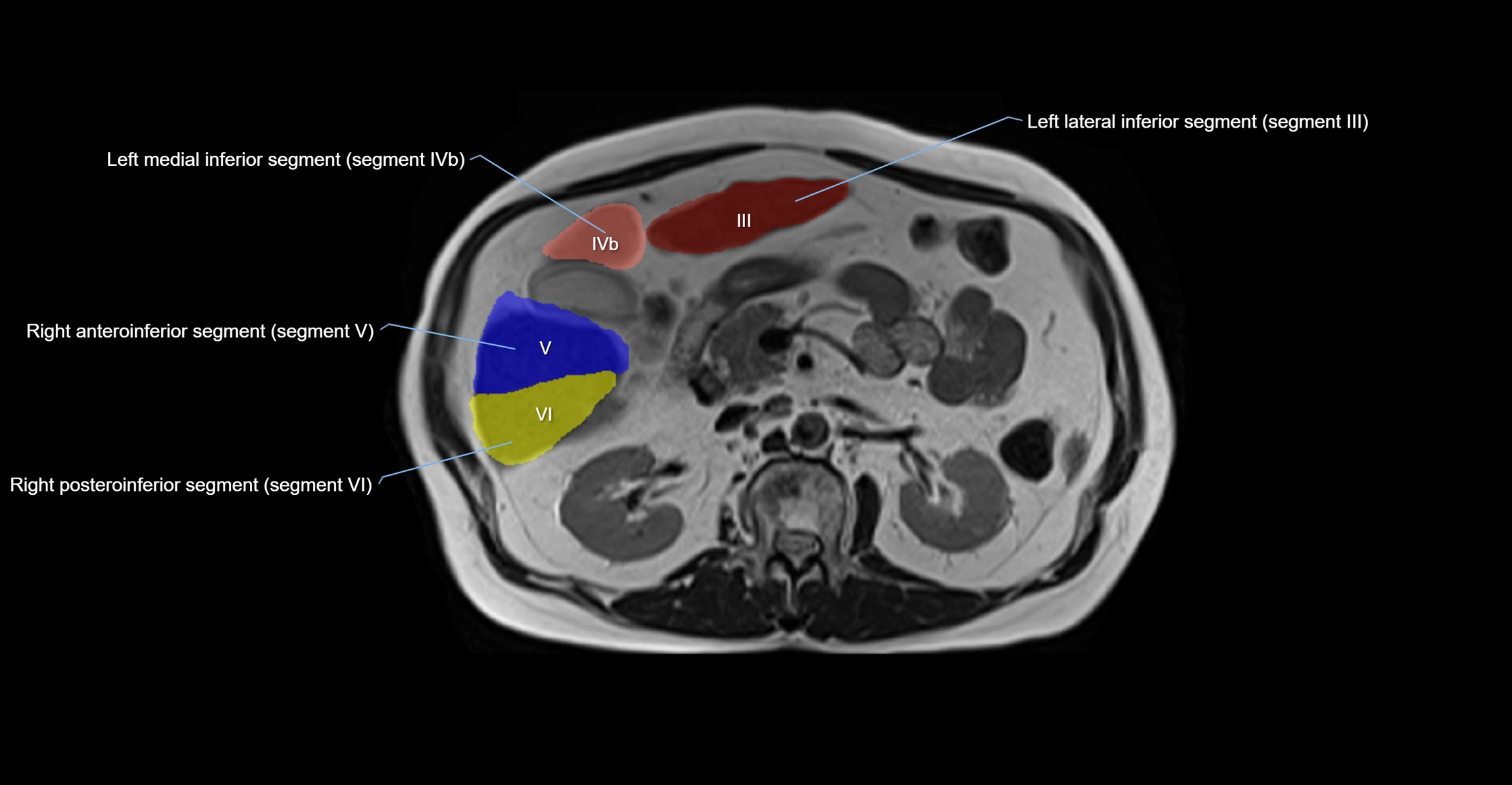 MRI  liver segments anatomy axial cross sectional 3T radiology  image-img-00001-00020.webp